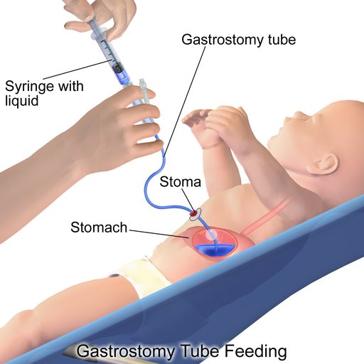 Infant Gastric Feeding Tube